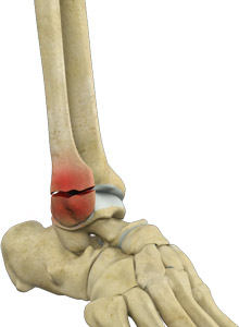 Ankle Fractures