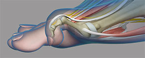 Common Toe Deformities