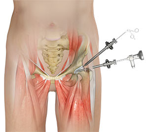 Hip Arthroscopy