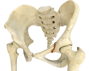 Hip Fracture