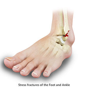 Stress Fractures of the Foot and Ankle