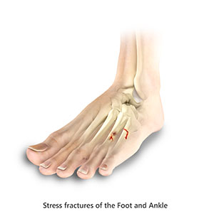 Toe and Forefoot Fractures