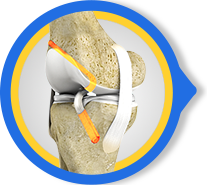 ACL Reconstruction